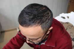 -大麦微针植发丨全国连锁