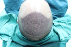 点击看大图 -大麦微针植发丨全国连锁