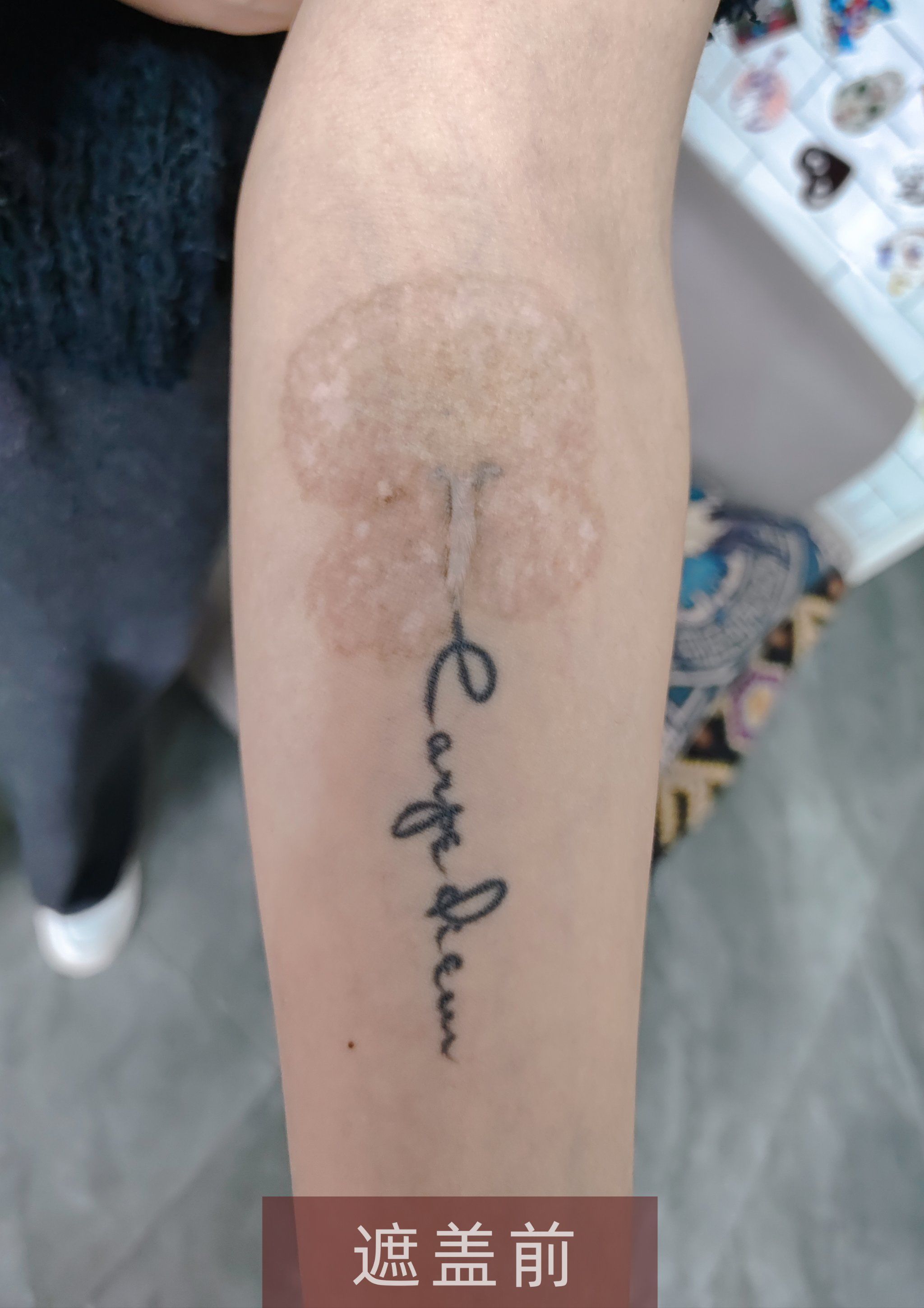洗了纹身留了个不小的疤 最终还是用纹身遮盖伤疤🥰