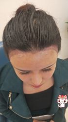 -大麦微针植发丨全国连锁