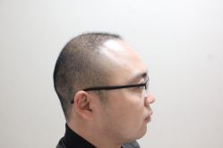 点击看大图 -大麦微针植发丨全国连锁