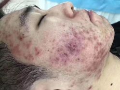 -苗方清颜痘肌研究所