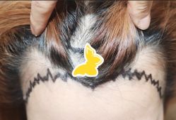 -大麦微针植发全国连锁