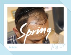 点击看大图 -大麦微针植发全国连锁