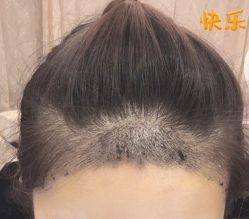 -大麦微针植发丨全国连锁