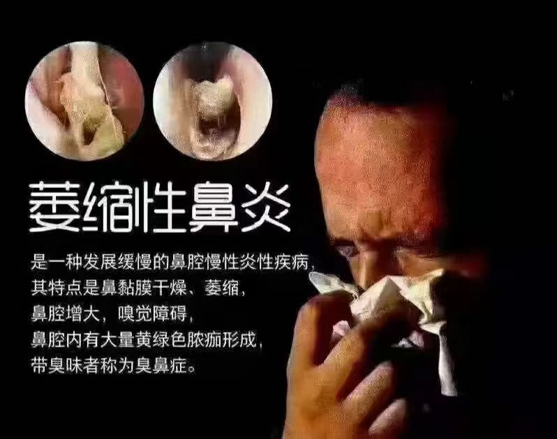 萎缩性鼻炎与其他鼻炎症状最明显的两个区别