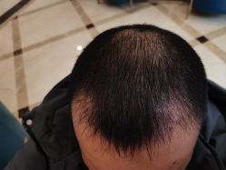 -碧莲盛·不剃发植发