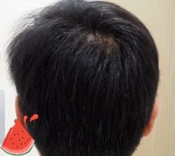 -大麦微针植发丨全国连锁