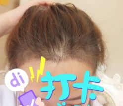 -大麦微针植发全国连锁