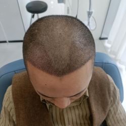 -大麦微针植发丨全国连锁