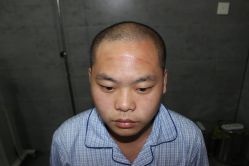 点击看大图 -大麦微针植发丨全国连锁