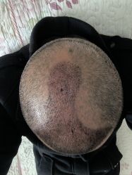 点击看大图 体验后-大麦微针植发丨全国连锁