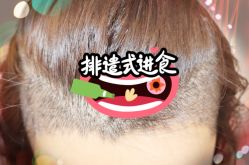 -大麦微针植发全国连锁