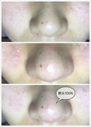 水氧+opt光疗-光SPA科技美肤