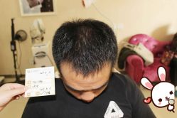 -大麦微针植发丨全国连锁