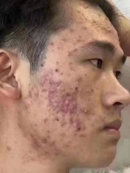 -瑶芳清颜草本祛痘