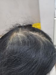 -大麦微针植发丨全国连锁