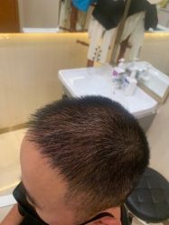 点击看大图 -碧莲盛·不剃发植发