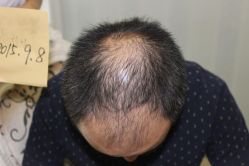 -大麦微针植发丨全国连锁