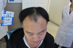 -大麦微针植发丨全国连锁