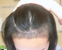 -大麦微针植发丨全国连锁