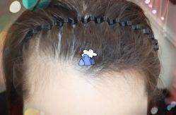 -大麦微针植发全国连锁