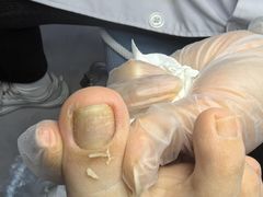 -世龙世家甲沟炎·灰指甲·嵌甲矫正·修脚(武侯区双楠店)