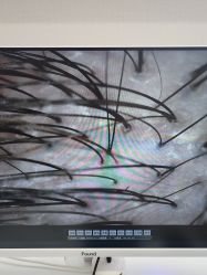 -大麦微针植发全国连锁