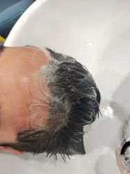 -大麦微针植发全国连锁