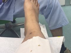 治疗后-Andrew指甲专科灰指甲·甲沟炎矫正·3D步态矫形鞋垫定制(上海法华镇路旗舰店)
