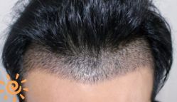 -大麦微针植发丨全国连锁