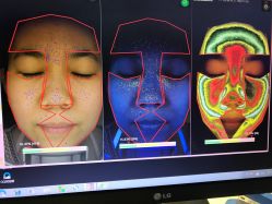 光SPA皮肤测试-光SPA科技美肤