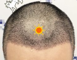 -大麦微针植发全国连锁