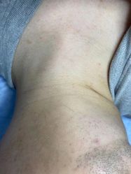-爱莎扁平疣·汗管瘤·斑痣中心