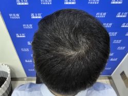 -碧莲盛·不剃发植发