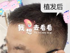 -大麦微针植发全国连锁