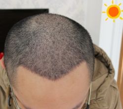 -大麦微针植发丨全国连锁