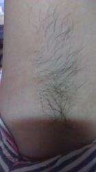 点击看大图 雪娃娃做完4次后的效果!一塌糊涂!-南京康美美容医院·旗舰店