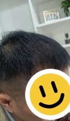 体验后-大麦微针植发丨全国连锁