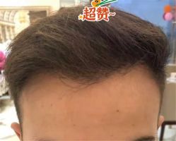 -大麦微针植发全国连锁