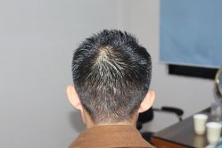 -大麦微针植发丨全国连锁