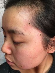 -北京美痣堂古方祛痣斑疣瘊
