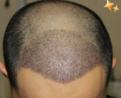 -大麦微针植发丨全国连锁