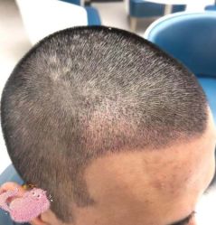 -大麦微针植发丨全国连锁