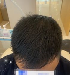-大麦微针植发丨全国连锁