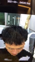 -大麦微针植发全国连锁