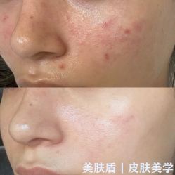 -美肤盾祛痘·问题肌头疗管理中心