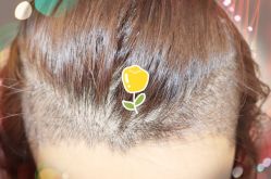 -大麦微针植发全国连锁