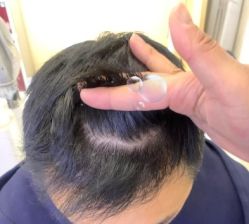 -大麦微针植发丨全国连锁