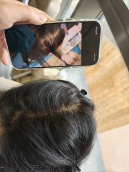 -碧莲盛·不剃发植发